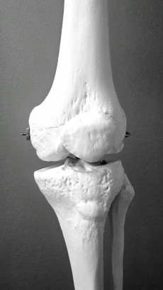 Osteoporosis