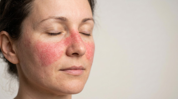 Lupus