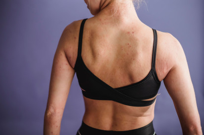 Atopic Dermatitis in Adults: When Moisturiser Isn't Enough