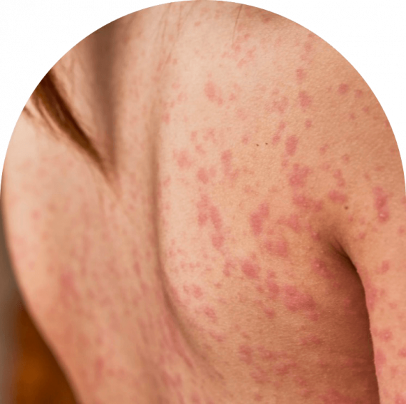 Psoriasis