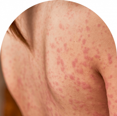 Psoriasis