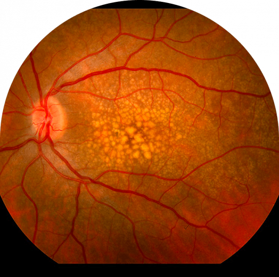 Macular Degeneration