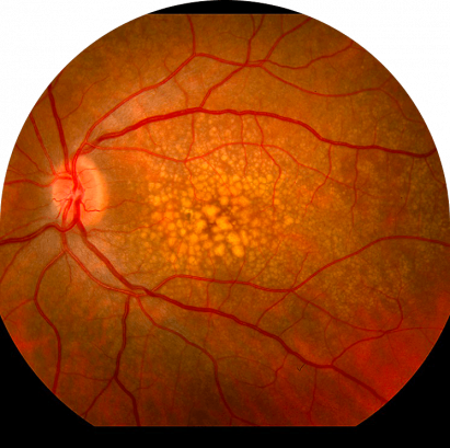 Macular Degeneration