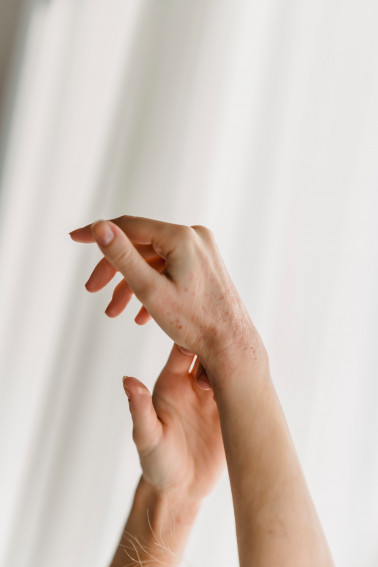 Eczema