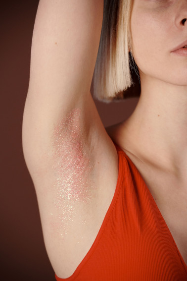 Hidradenitis Suppurativa